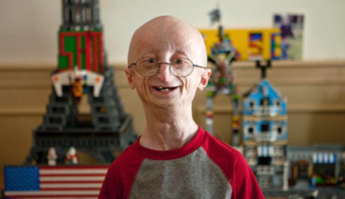 progeria